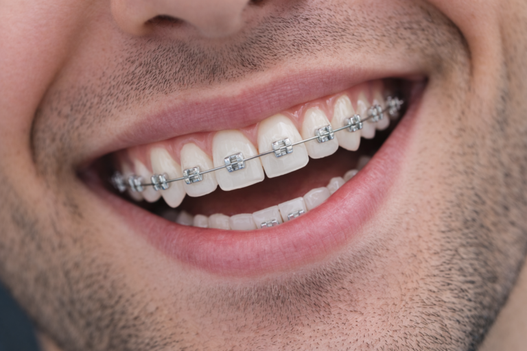 โปรโมชั่นจัดฟันเหล็กที่ SB Smile Dental Clinic